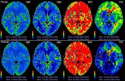 Cerebral Hemodynamic Changes After Revascularization in Patients With Hemorrhagic Moyamoya Disease